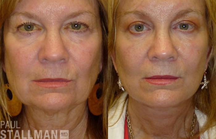Before & After Face Lift Case 109 View #1 View in Fresno, Santa Maria, San Luis Obispo, CA