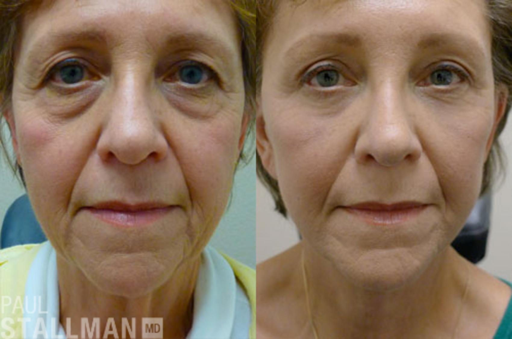 Before & After Face Lift Case 111 View #1 View in Fresno, Santa Maria, San Luis Obispo, CA
