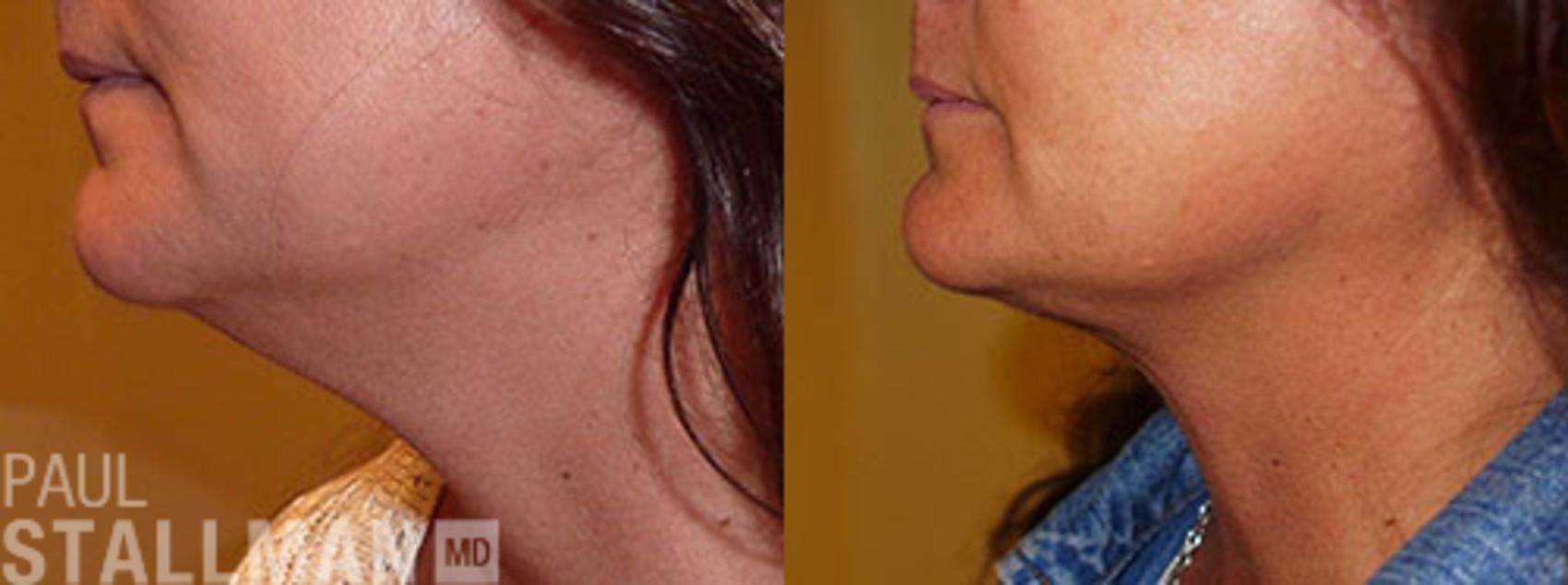 Before & After Facial Liposuction Case 112 View #1 View in Fresno, Santa Maria, San Luis Obispo, CA