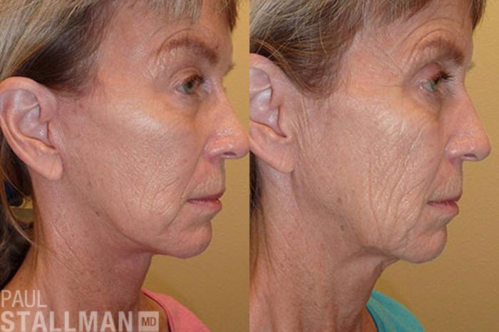 Before & After Face Lift Case 75 View #2 View in Fresno, Santa Maria, San Luis Obispo, CA