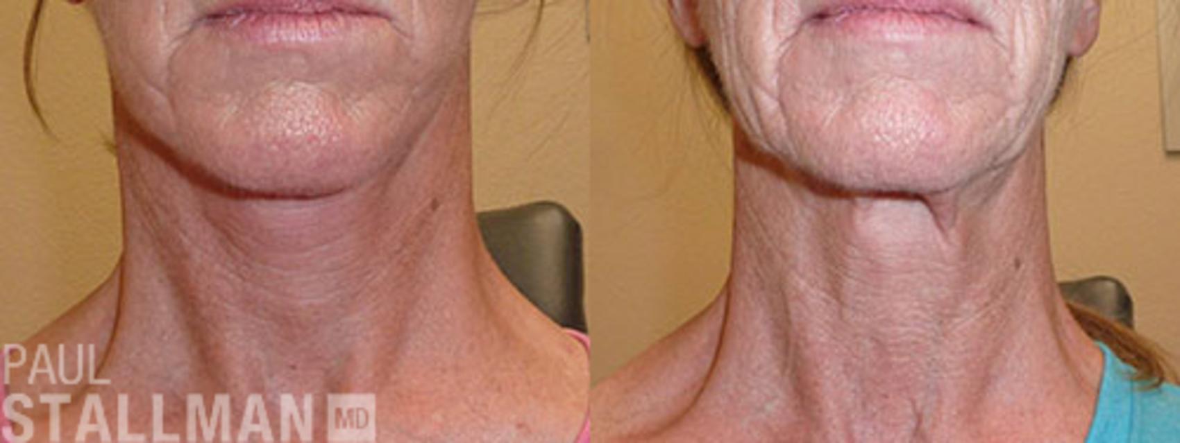 Before & After Face Lift Case 75 View #3 View in Fresno, Santa Maria, San Luis Obispo, CA