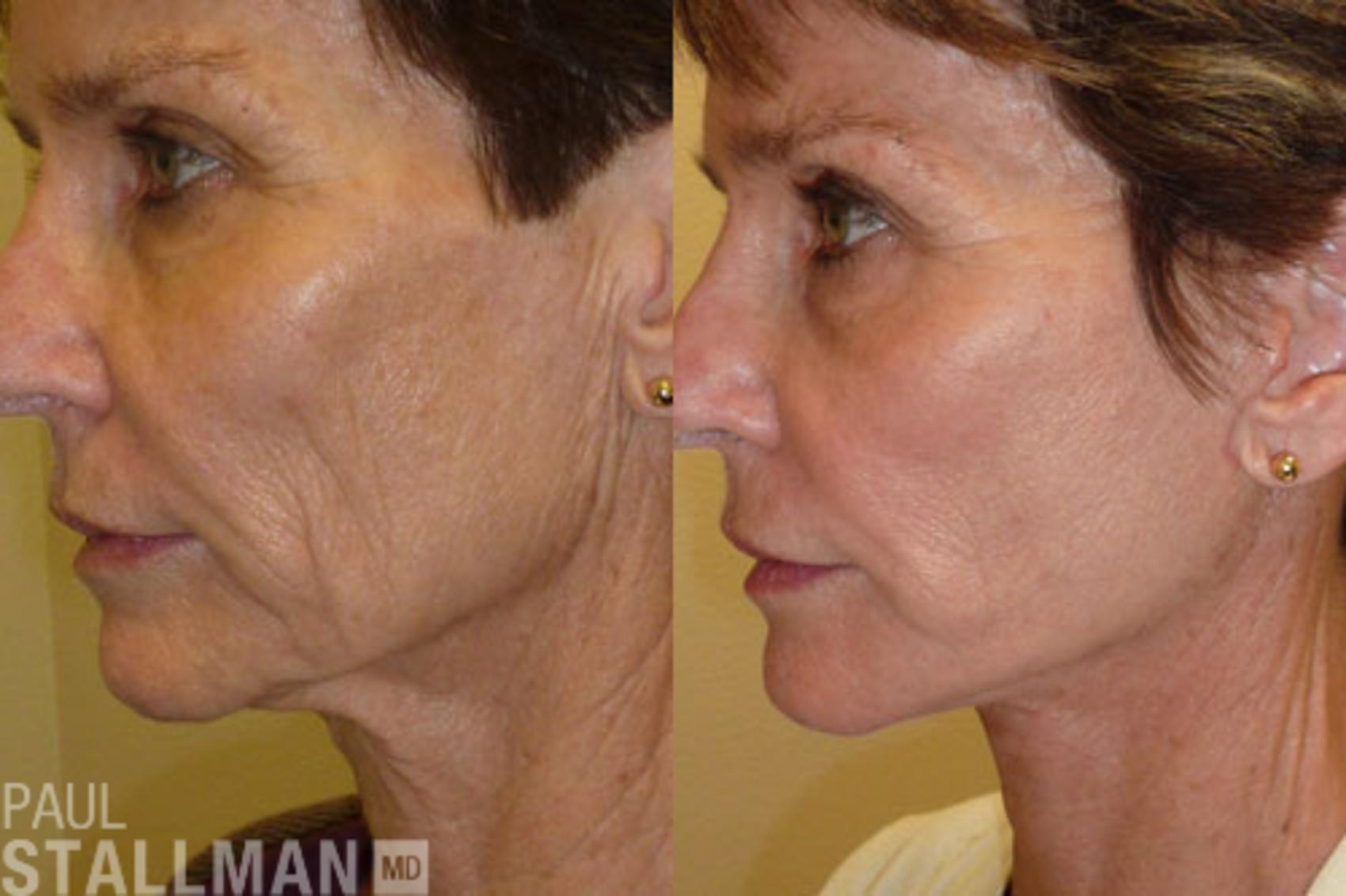 Before & After Face Lift Case 78 View #1 View in Fresno, Santa Maria, San Luis Obispo, CA