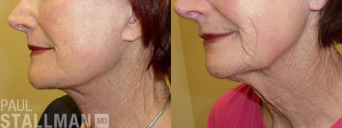 Before & After Face Lift Case 79 View #2 View in Fresno, Santa Maria, San Luis Obispo, CA
