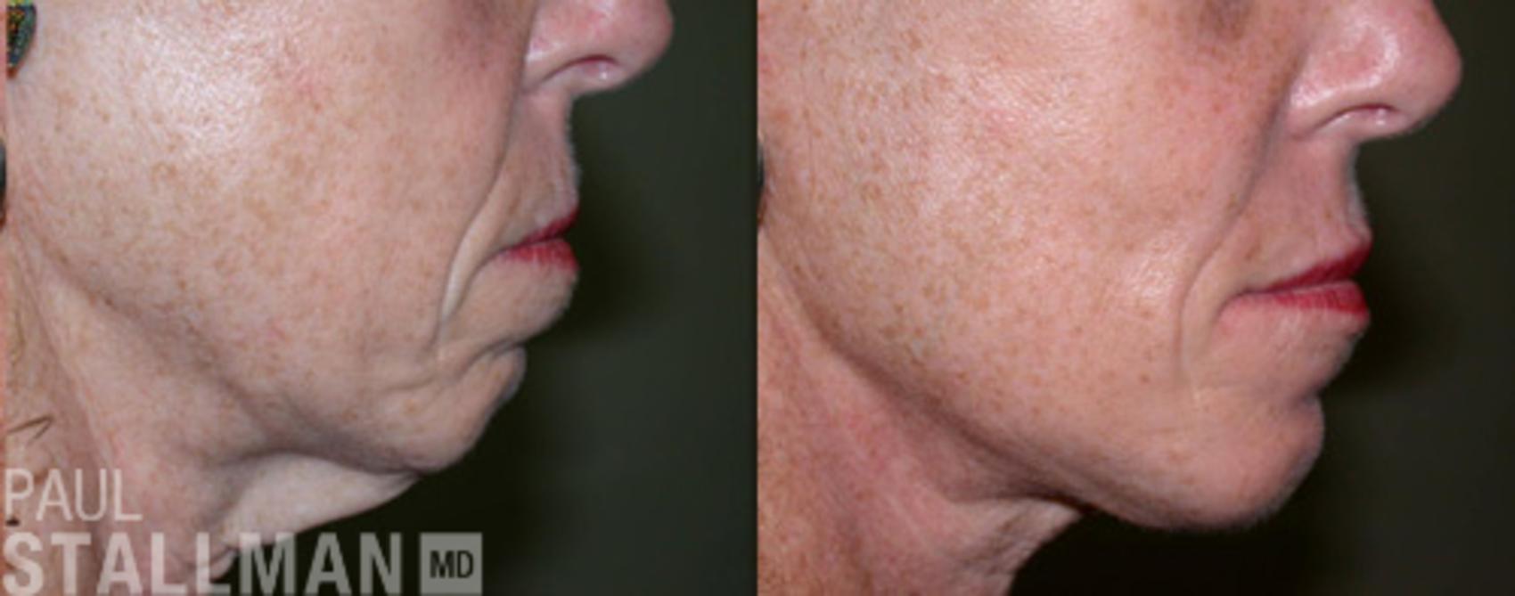 Before & After Face Lift Case 80 View #1 View in Fresno, Santa Maria, San Luis Obispo, CA
