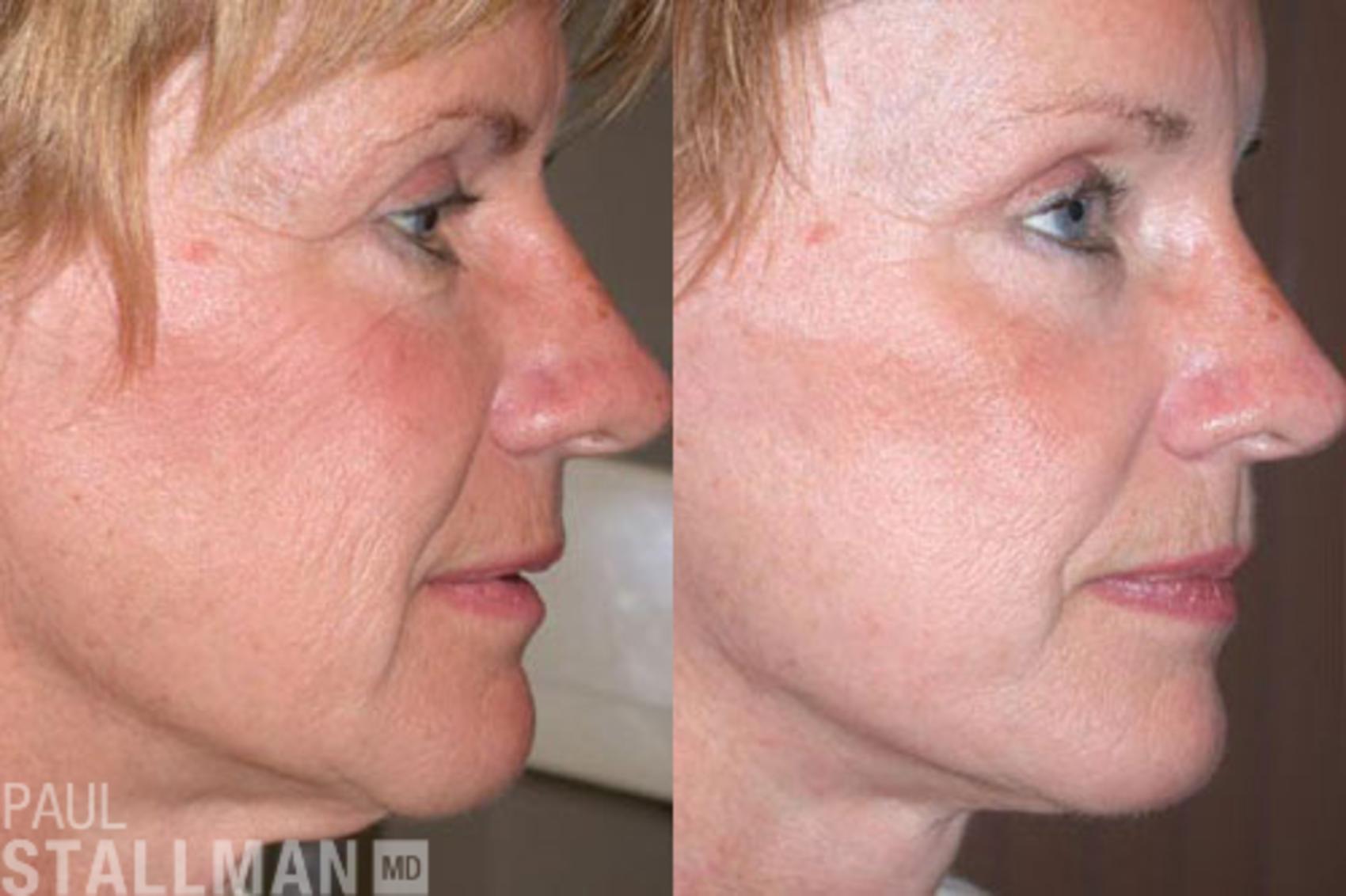 Before & After Face Lift Case 81 View #1 View in Fresno, Santa Maria, San Luis Obispo, CA