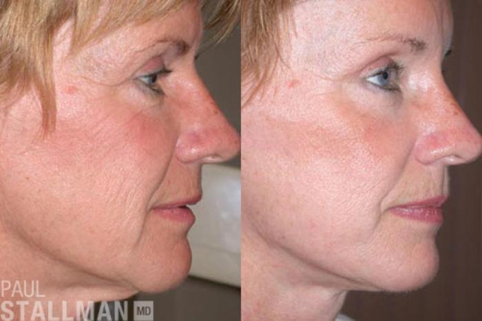 Before & After Face Lift Case 81 View #1 View in Fresno, Santa Maria, San Luis Obispo, CA