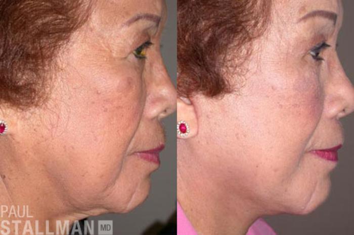 Before & After Face Lift Case 83 View #1 View in Fresno, Santa Maria, San Luis Obispo, CA