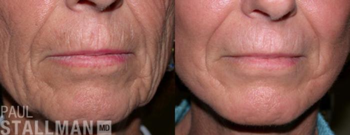 Before & After Face Lift Case 85 View #1 View in Fresno, Santa Maria, San Luis Obispo, CA