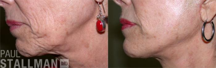 Before & After Face Lift Case 90 View #1 View in Fresno, Santa Maria, San Luis Obispo, CA