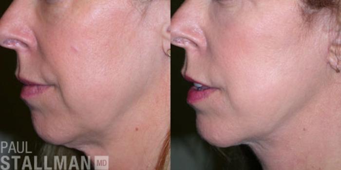 Before & After Face Lift Case 92 View #1 View in Fresno, Santa Maria, San Luis Obispo, CA