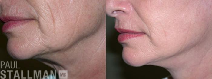 Before & After Face Lift Case 93 View #1 View in Fresno, Santa Maria, San Luis Obispo, CA