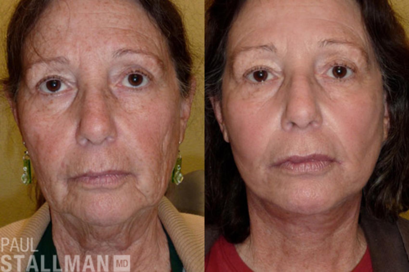 Before & After Face Lift Case 98 View #1 View in Fresno, Santa Maria, San Luis Obispo, CA