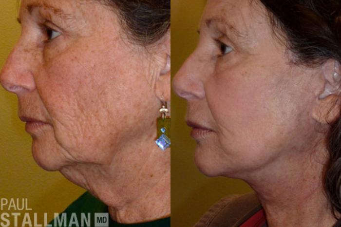 Before & After Face Lift Case 98 View #2 View in Fresno, Santa Maria, San Luis Obispo, CA