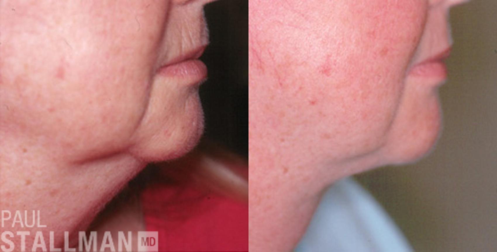 Before & After Facial Liposuction Case 113 View #1 View in Fresno, Santa Maria, San Luis Obispo, CA