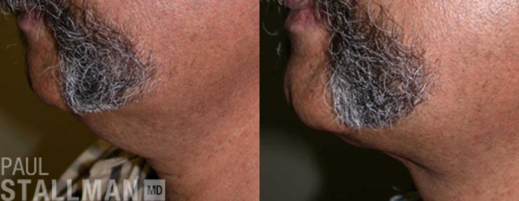 Before & After Facial Liposuction Case 114 View #1 View in Fresno, Santa Maria, San Luis Obispo, CA