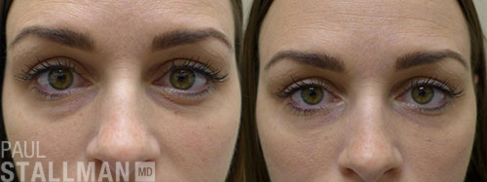 Before & After Injectable Fillers Case 116 View #1 View in Fresno, Santa Maria, San Luis Obispo, CA