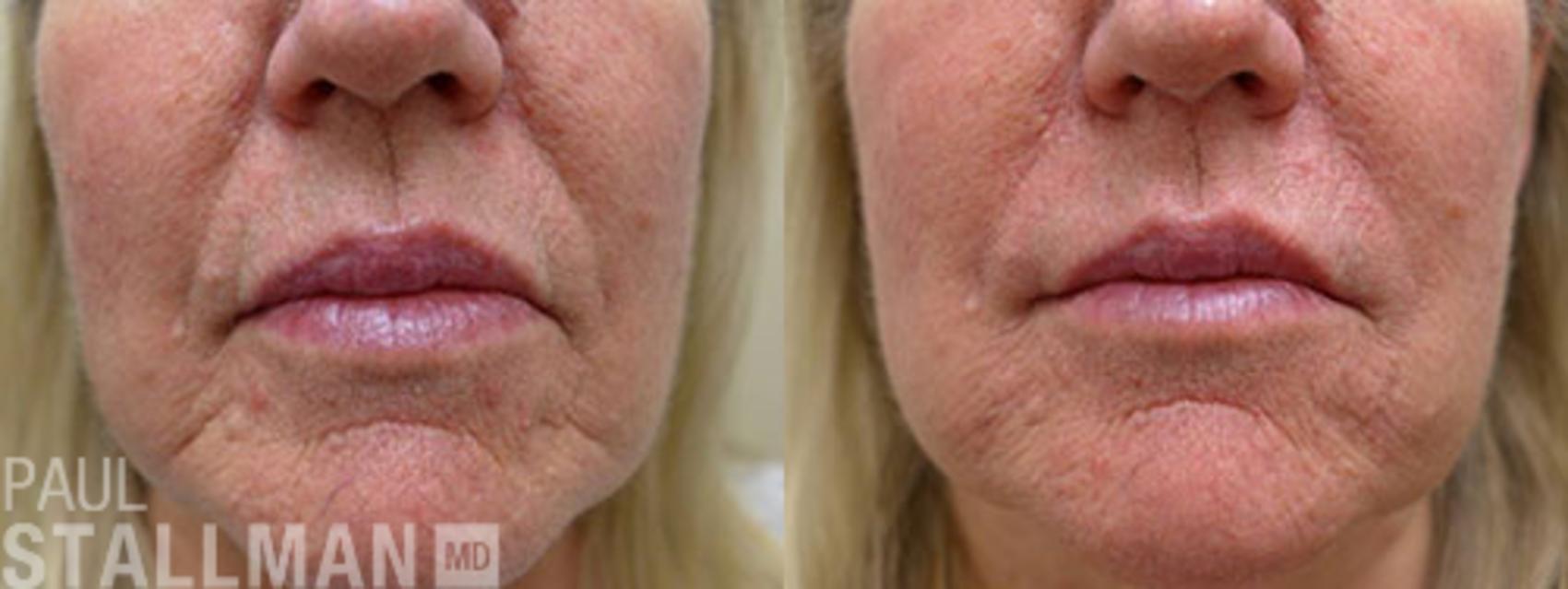 Before & After Injectable Fillers Case 117 View #1 View in Fresno, Santa Maria, San Luis Obispo, CA