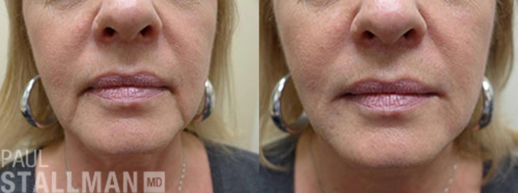 Before & After Injectable Fillers Case 118 View #1 View in Fresno, Santa Maria, San Luis Obispo, CA
