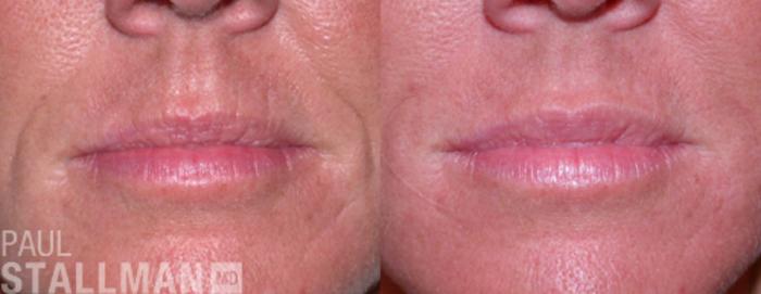 Before & After Injectable Fillers Case 119 View #1 View in Fresno, Santa Maria, San Luis Obispo, CA