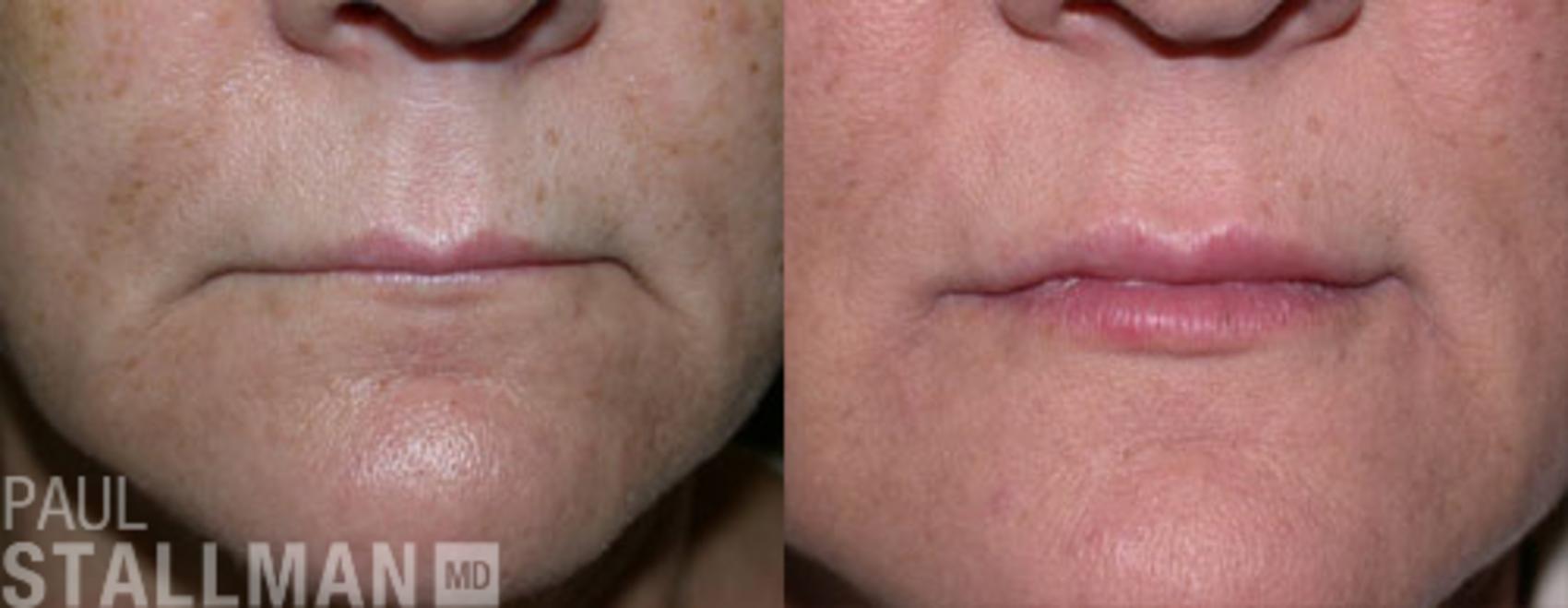 Injectable Fillers Before And After Pictures Case 120 Fresno Santa Maria San Luis Obispo Ca 