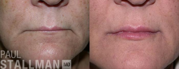 Before & After Injectable Fillers Case 120 View #1 View in Fresno, Santa Maria, San Luis Obispo, CA