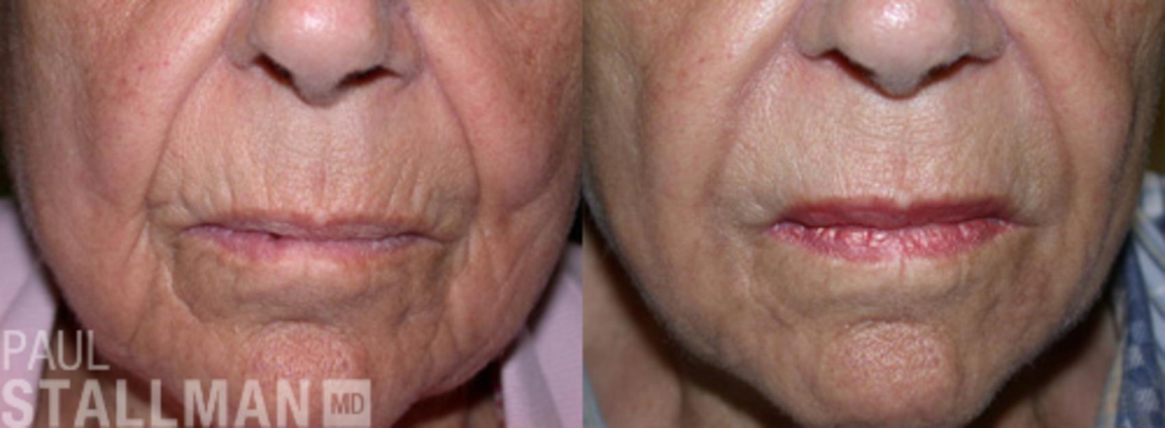 Before & After Injectable Fillers Case 121 View #1 View in Fresno, Santa Maria, San Luis Obispo, CA