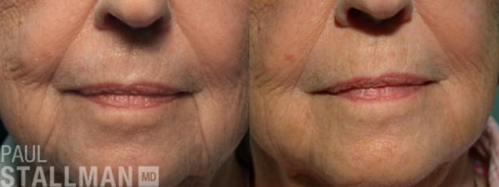 Before & After Injectable Fillers Case 122 View #1 View in Fresno, Santa Maria, San Luis Obispo, CA