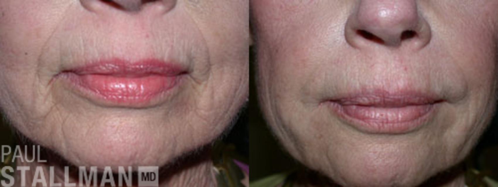 Before & After Injectable Fillers Case 123 View #1 View in Fresno, Santa Maria, San Luis Obispo, CA