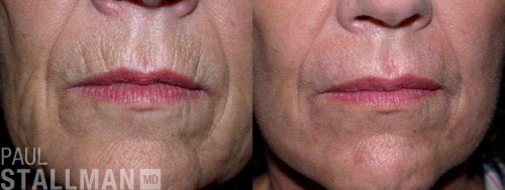 Before & After Injectable Fillers Case 125 View #1 View in Fresno, Santa Maria, San Luis Obispo, CA