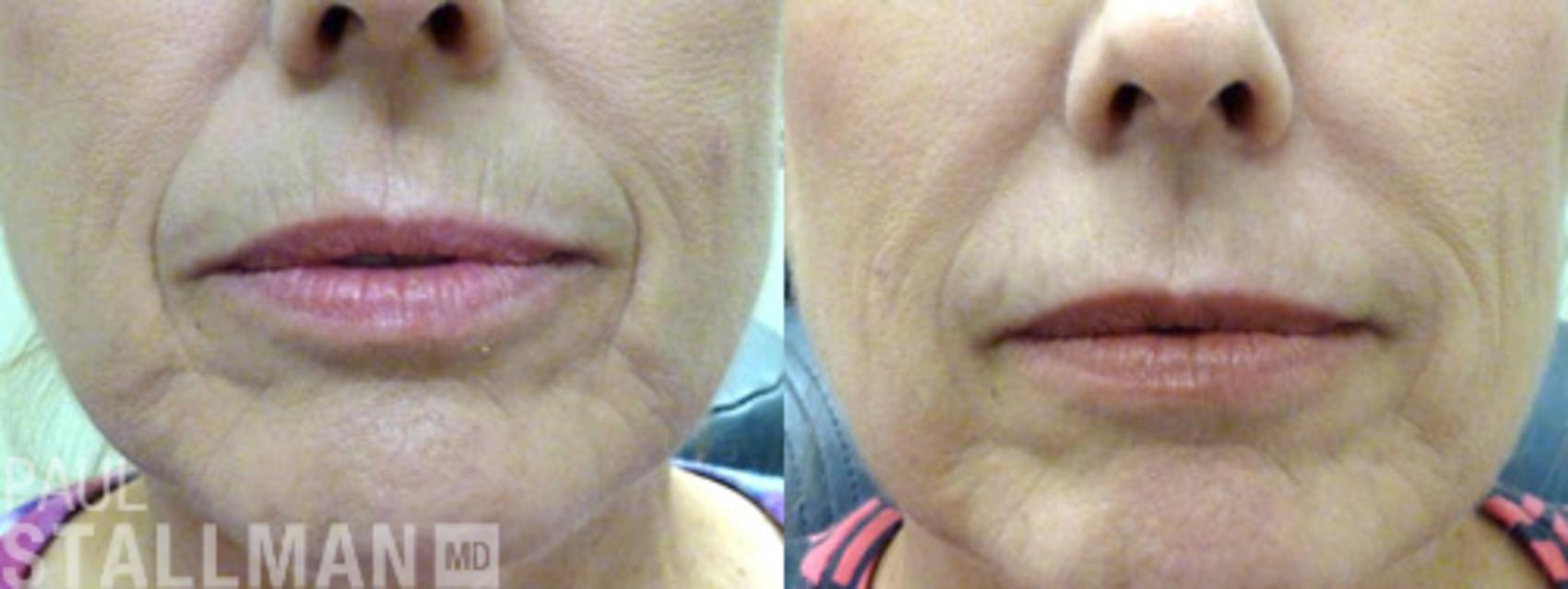 Before & After Injectable Fillers Case 126 View #1 View in Fresno, Santa Maria, San Luis Obispo, CA