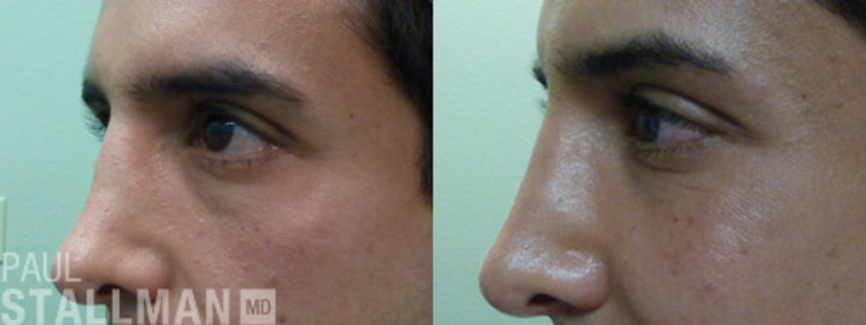 Before & After Injectable Fillers Case 127 View #1 View in Fresno, Santa Maria, San Luis Obispo, CA