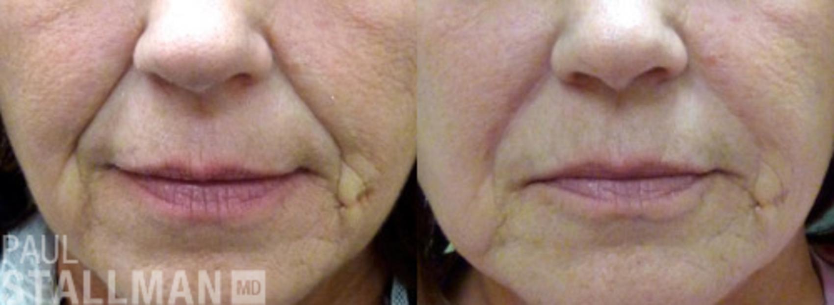 Before & After Injectable Fillers Case 128 View #1 View in Fresno, Santa Maria, San Luis Obispo, CA
