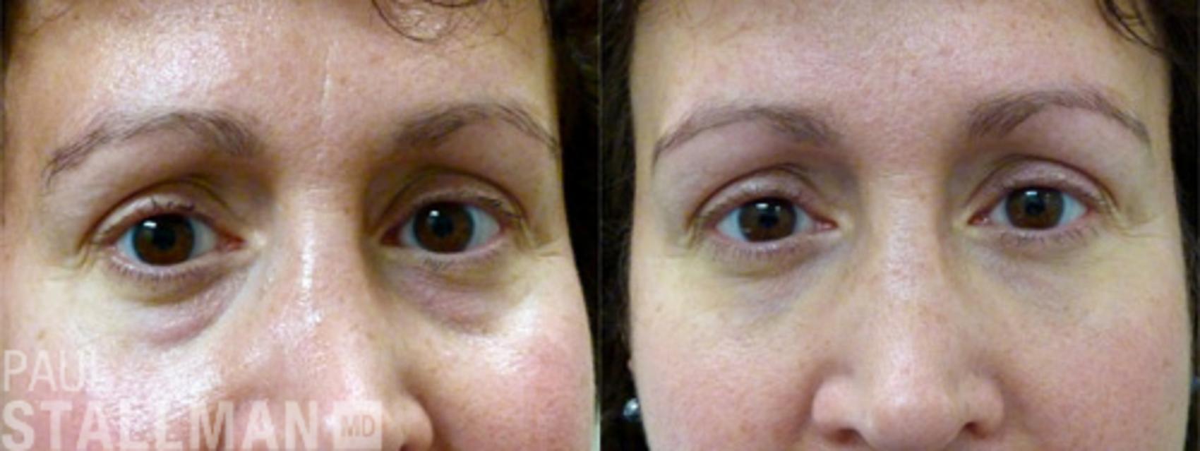 Before & After Injectable Fillers Case 129 View #1 View in Fresno, Santa Maria, San Luis Obispo, CA