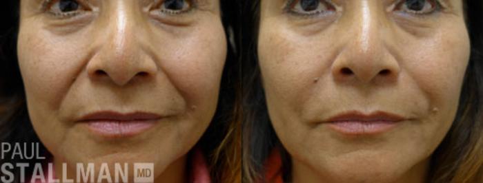 Before & After Injectable Fillers Case 130 View #1 View in Fresno, Santa Maria, San Luis Obispo, CA