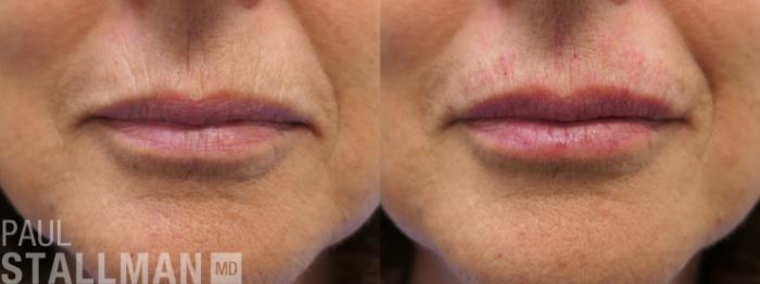Before & After Injectable Fillers Case 191 Front View in Fresno, Santa Maria, San Luis Obispo, CA