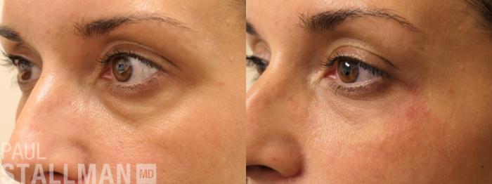 Before & After Injectable Fillers Case 193 Left Oblique View in Fresno, Santa Maria, San Luis Obispo, CA