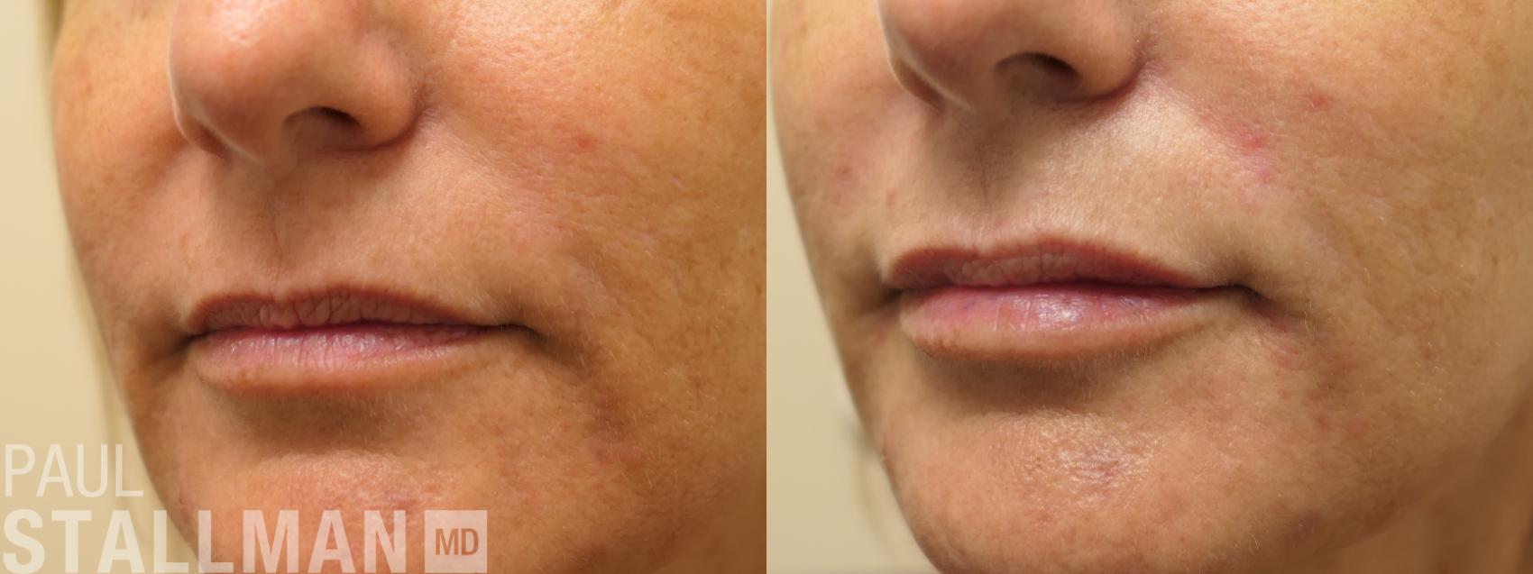 Before & After Injectable Fillers Case 194 Left Oblique View in Fresno, Santa Maria, San Luis Obispo, CA