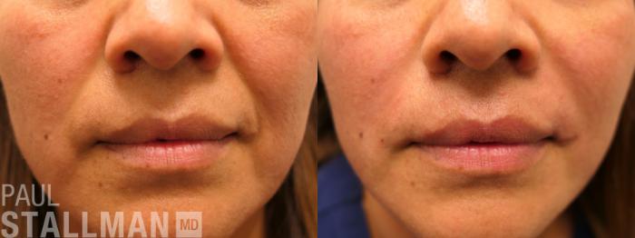 Before & After Injectable Fillers Case 195 Front View in Fresno, Santa Maria, San Luis Obispo, CA