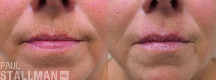 Before & After Injectable Fillers Case 196 Front View in Fresno, Santa Maria, San Luis Obispo, CA