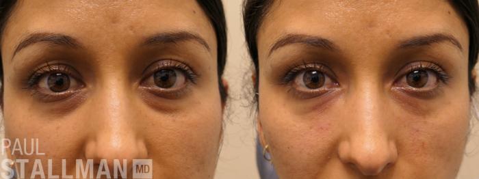 Before & After Injectable Fillers Case 197 Front View in Fresno, Santa Maria, San Luis Obispo, CA