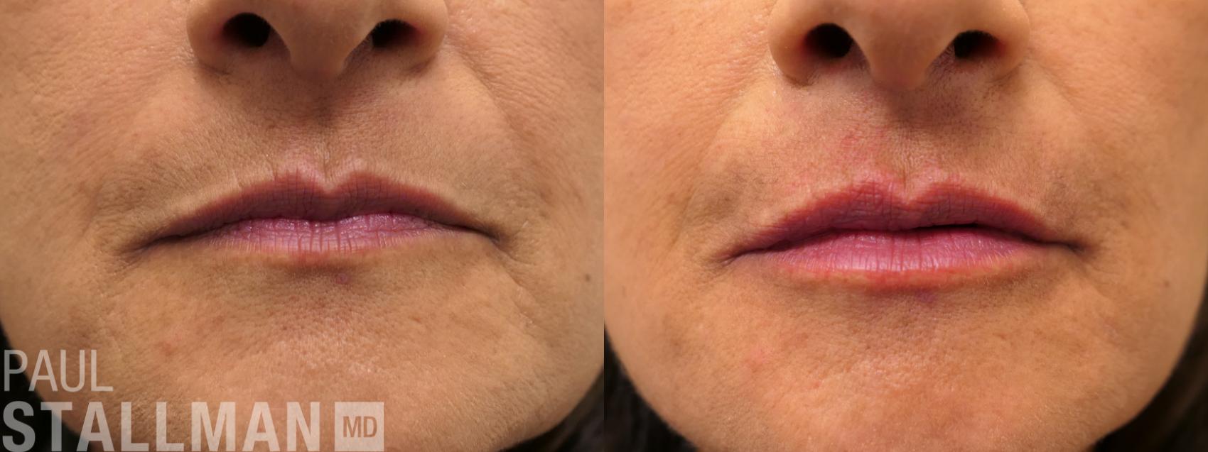 Before & After Injectable Fillers Case 198 Front View in Fresno, Santa Maria, San Luis Obispo, CA