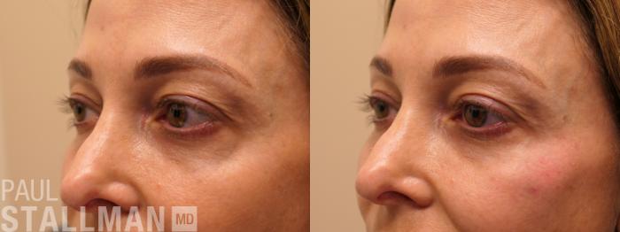 Before & After Injectable Fillers Case 199 Left Side View in Fresno, Santa Maria, San Luis Obispo, CA