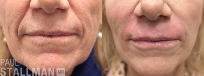 Before & After Injectable Fillers Case 200 Front View in Fresno, Santa Maria, San Luis Obispo, CA