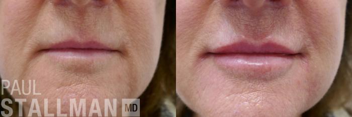 Before & After Injectable Fillers Case 214 Front View in Fresno, Santa Maria, San Luis Obispo, CA