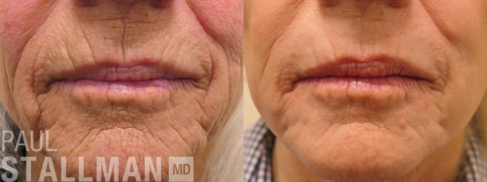 Before & After Laser Resurfacing Case 159 Front View in Fresno, Santa Maria, San Luis Obispo, CA