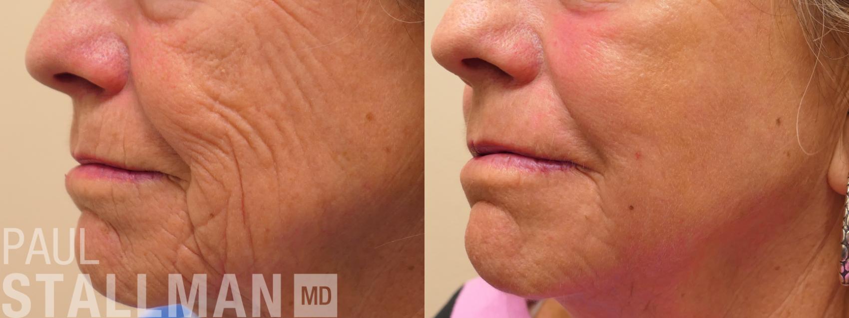 Before & After Laser Resurfacing Case 160 Front View in Fresno, Santa Maria, San Luis Obispo, CA