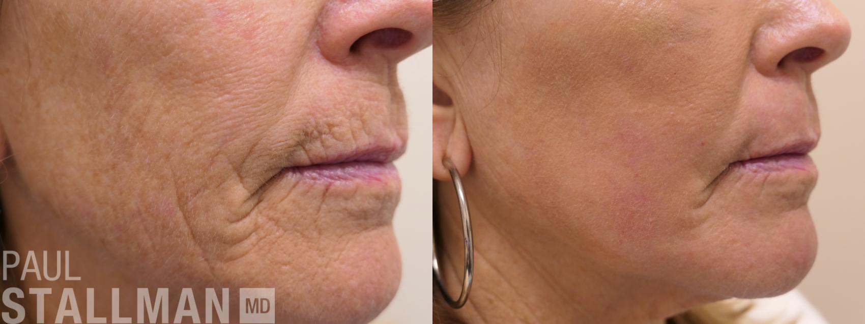 Before & After Laser Resurfacing Case 162 Right Side View in Fresno, Santa Maria, San Luis Obispo, CA
