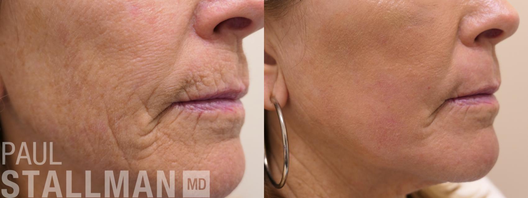 Before & After Laser Resurfacing Case 162 Right Side View in Fresno, Santa Maria, San Luis Obispo, CA