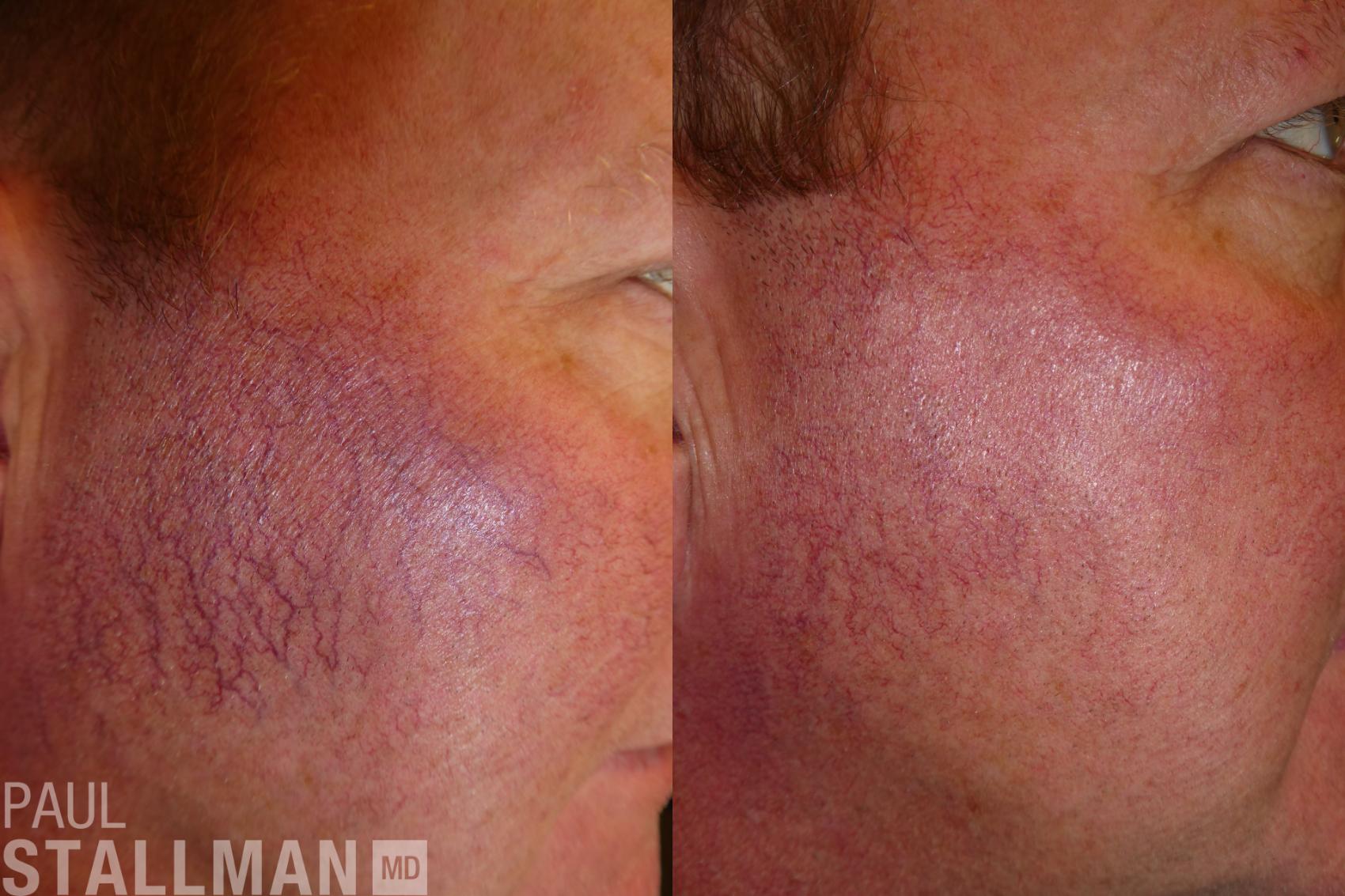 Before & After Laser Resurfacing Case 163 Right Side View in Fresno, Santa Maria, San Luis Obispo, CA