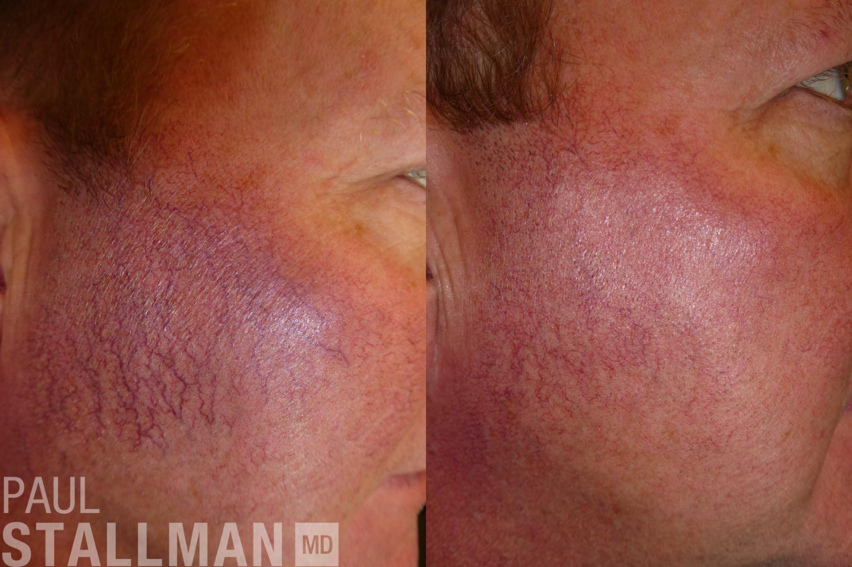 Before & After Laser Resurfacing Case 163 Right Side View in Fresno, Santa Maria, San Luis Obispo, CA